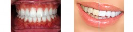 歯 セラミック 保険 歯並び 矯正 歯並び 矯正 費用 歯並び 矯正 歯科